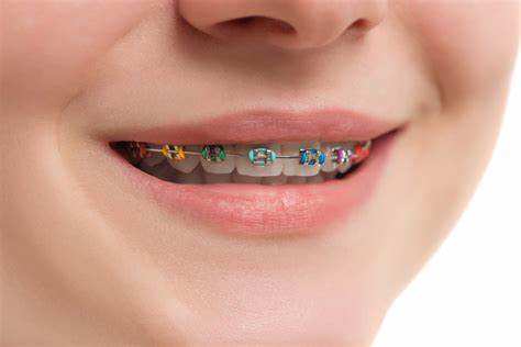 Can a Dentist Remove Plaque with Braces?