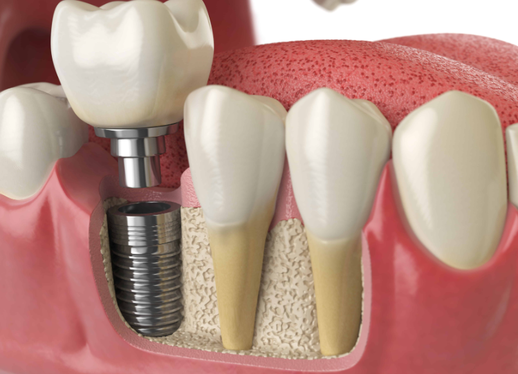  Dental Implant 