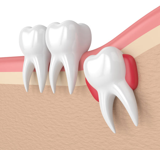 When Should I Start my Wisdom Tooth Medicine